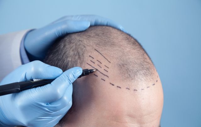 HAIR TRANSPLANT IN TURKEY